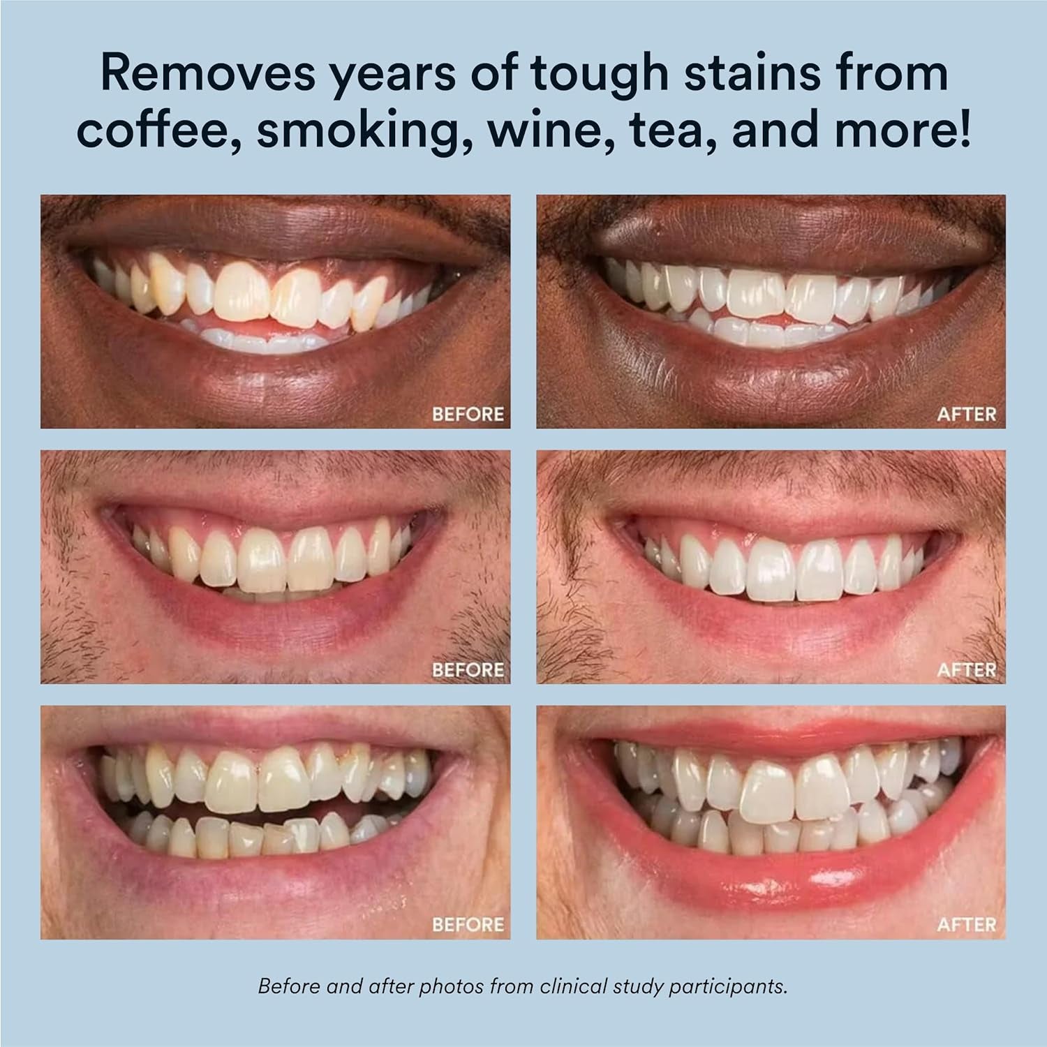 Teeth Whitening Kit, LED Accelerator Light, 35% Carbamide Peroxide Teeth Whitening Gel, 20+ Whitening Treatments, Whitens up to 10 Shades in 7 Days